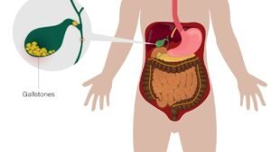 Which Size of Gallbladder Stone Is Dangerous? Dr. Pawanindra Lal