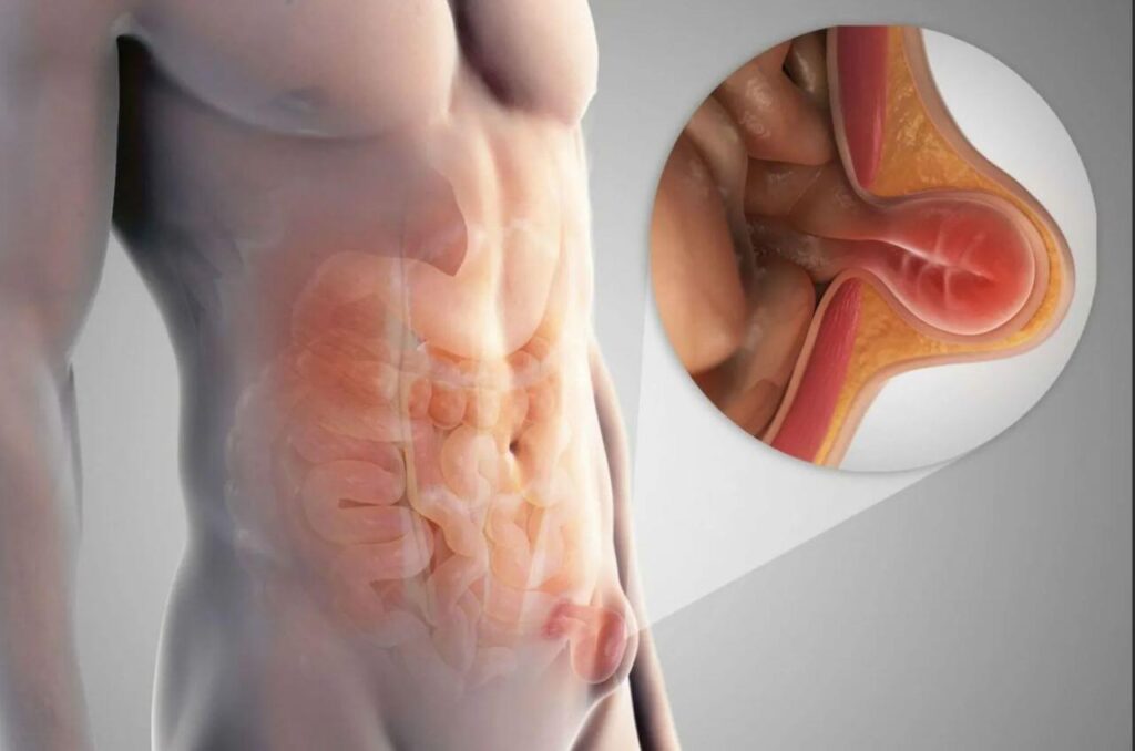 hernia