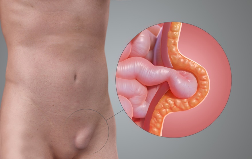 How to Prevent Hernia