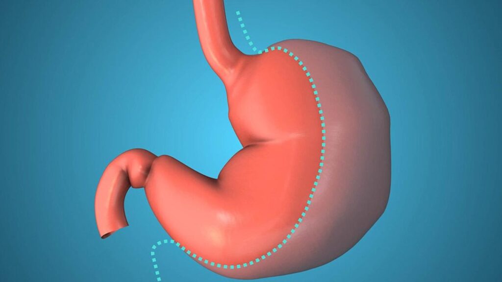 Is Bariatric Surgery Covered by Insurance